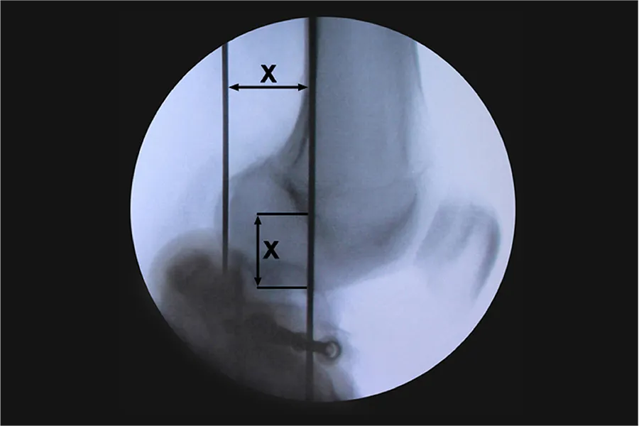 Fijador externo articulado para Rodilla · imagen 3