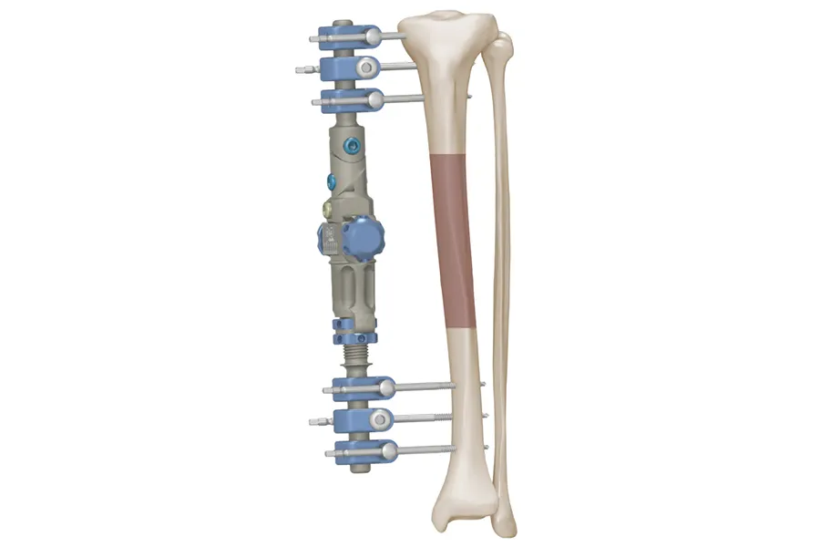 Fijador externo monolateral Fémur · imagen 3