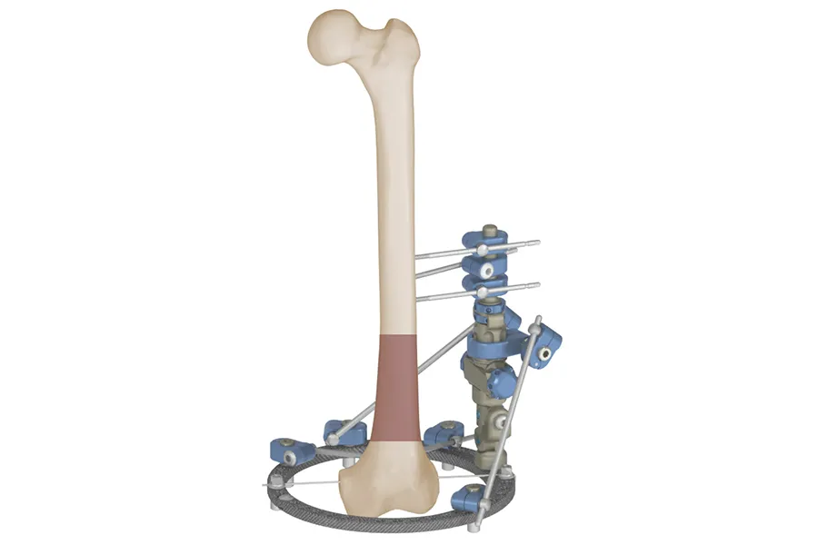 Fijador externo monolateral Fémur · imagen 4
