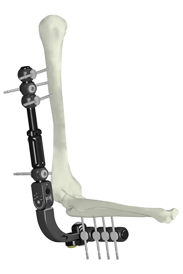 Fijador Externo Articulado Codo · imagen 4